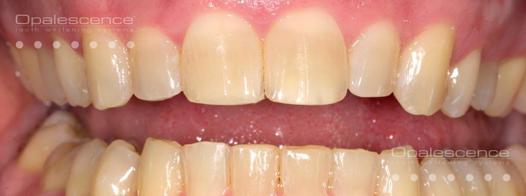 Før tandblegning med Opalescence-systemet
